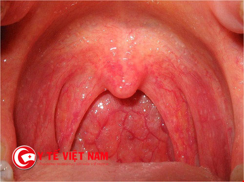 Viêm họng cấp tính là loại bệnh phổ biến, thường xuất hiện và khởi phát đột ngột
