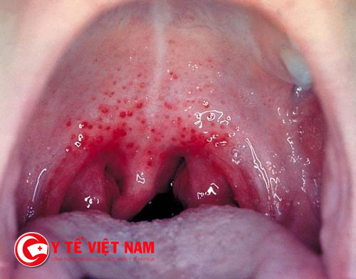 Viêm họng mạn tính tái phát nhiều lần sẽ dẫn đến viêm họng hạt.