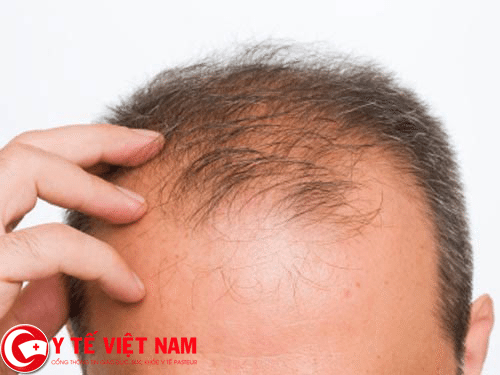 Bệnh nấm da đầu gây hói đầu