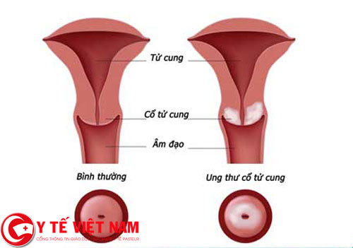 Bệnh ung thư cổ tử cung thường xảy ra ở phụ nữ