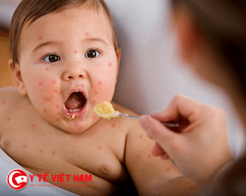 Trẻ bị tay chân miệng nên ăn gì?