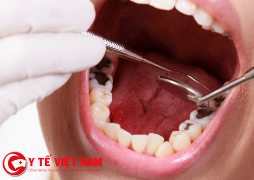 Nguyên nhân gây sâu răng là gì?