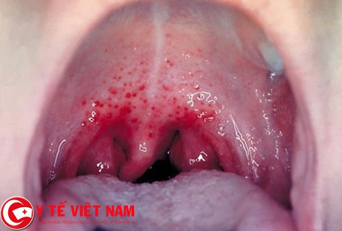 Dấu hiệu của bệnh ung thư vòm họng