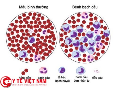 Dấu hiệu của bệnh ung thư máu