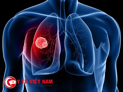 Ung thư phổi gây ra 20% cái chết trong tất cả các trường hợp chết do ung thư