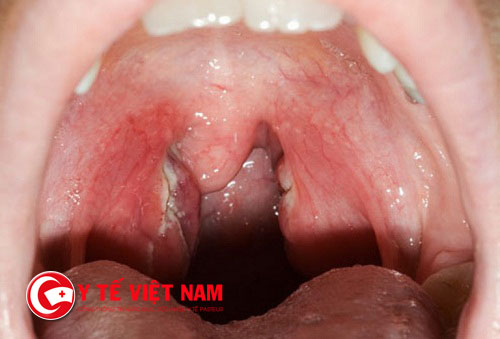 Viêm amidan là hiện tượng vi khuẩn và virus xâm nhập và tấn công ở cổ họng