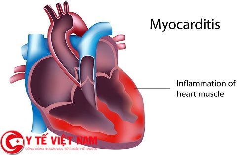 Bệnh viêm cơ tim là gì?