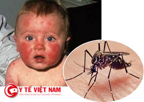 Dấu hiệu virus zika ở trẻ