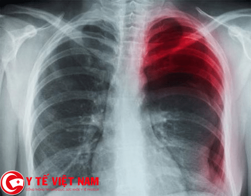 Bệnh tràn dịch màng phổi nguy hiểm