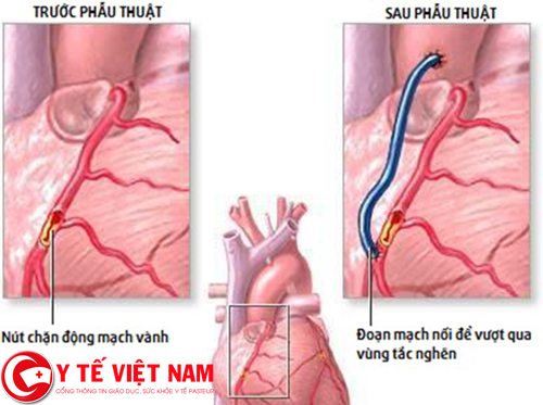 Phương pháp bắc cầu động mạch vành