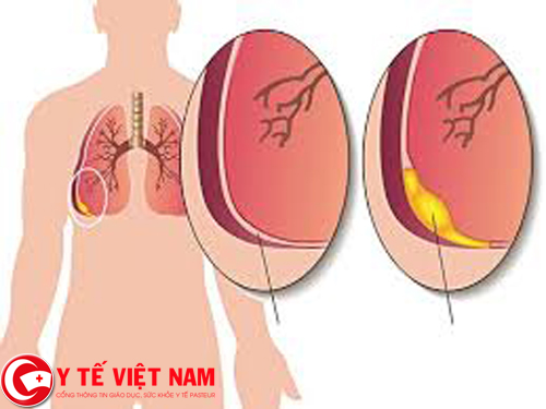 Phương pháp điều trị bệnh viêm màng phổi
