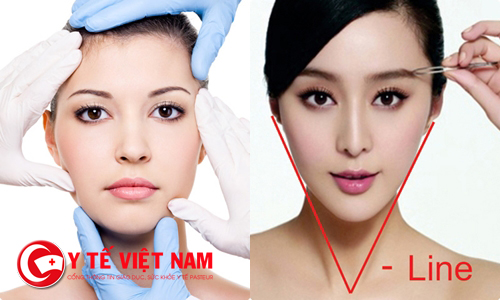 Phẫu thuật gọt mặt là phương pháp sở hữu khuôn mặt V line nhanh chóng