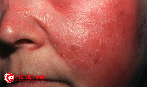 Nhiễm trùng da là biến chứng của bệnh viêm da dị ứng cơ địa ở mặt