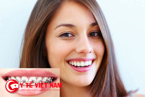 Niềng răng là giải pháp tối ưu nhất trong khi thẩm mỹ răng cửa thưa