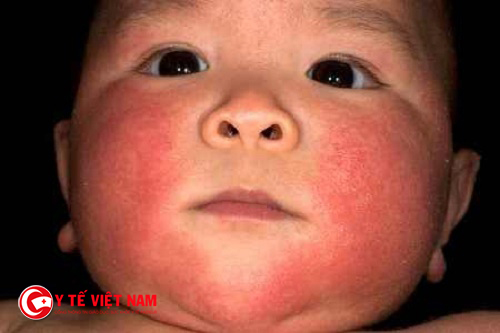 HÌnh ảnh của bệnh viêm da dị ứng cơ địa ở trẻ em