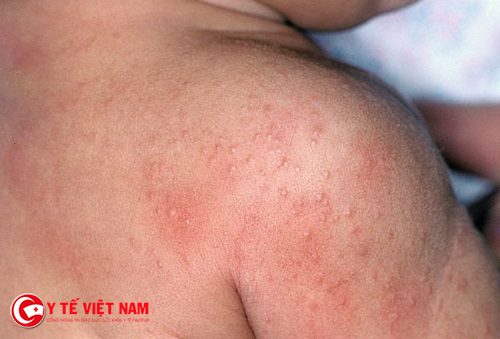 Biểu hiện đặc trưng của bệnh viêm da dị ứng là nổi ban đỏ