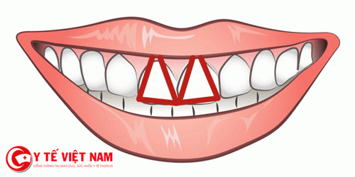 Răng cửa hình tam giác