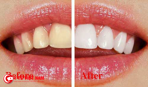 Tẩy trắng răng giúp bạn lấy lại hàm răng trắng sáng một cách tự nhiên