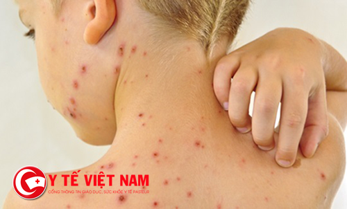 Tuyệt đối không gãi vào các nốt thủy đậu Tuyệt đối không gãi vào các nốt thủy đậu