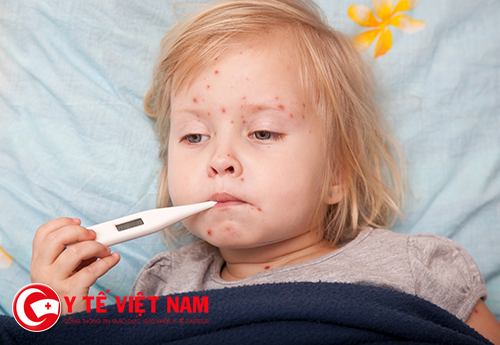 Dấu hiệu và cách chăm sóc bệnh nhân bị thủy đậu Dấu hiệu và cách chăm sóc bệnh nhân bị thủy đậu