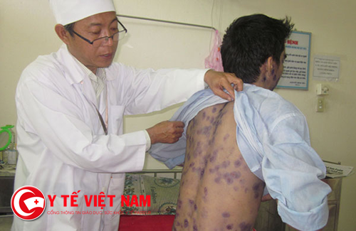 Cần tham khảo ý kiến bác sĩ khi điều trị bệnh thủy đậu Cần tham khảo ý kiến bác sĩ khi điều trị bệnh thủy đậu
