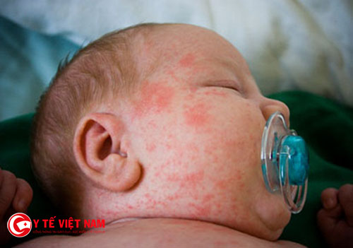 Dấu hiệu ban đỏ ở trẻ mắc sốt phát ban