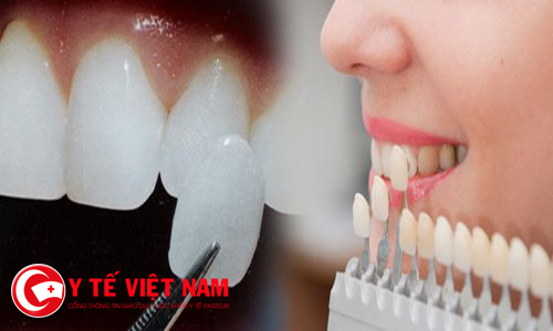 Dán răng sứ thẩm mỹ - cách phục hồi răng hư tổn nhanh nhất