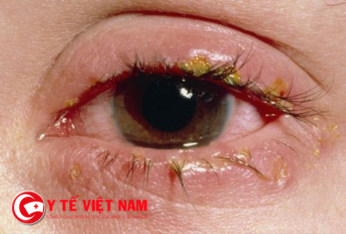 Thầy thuốc tư vấn bị đau mắt đỏ kiêng ăn gì? Thầy thuốc tư vấn bị đau mắt đỏ kiêng ăn gì?