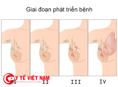 Các giai đoạn phát triển bệnh ung thư vú Các giai đoạn phát triển bệnh ung thư vú