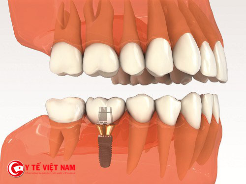 Trước khi thực hiện việc trồng răng bằng Implant cần phải xét nghiệm kỹ