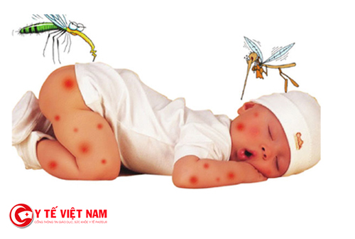 Xuất huyết dưới da rất hay gặp ở trẻ mắc bệnh sốt xuất huyết
