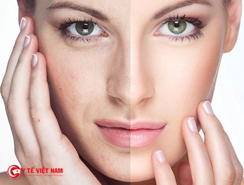 Căng da mặt không phẫu thuật giúp làn da căng mịn tự nhiên