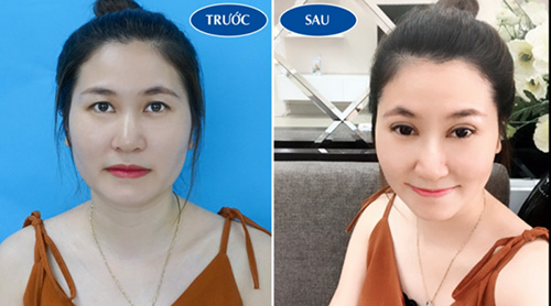 Hình ảnh kết quả khách hàng sau khi thực hiện nhấn mí tại Viện thẩm mỹ Hà Nội