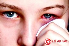 Nguy cơ bùng phát dịch đau mắt đỏ tại nhiều địa phương vùng lũ