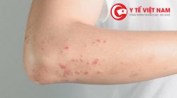 Bị phát ban trên da có thể là dấu hiệu nhiễm HIV