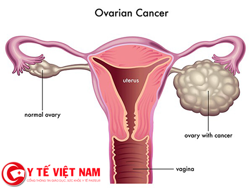 Ung thư buồng trứng đang ngày càng gia tăng ở nữ giới
