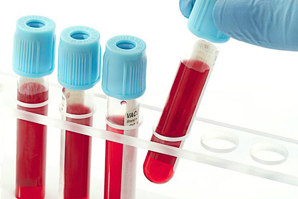 Xét nghiệm máu để giúp chẩn đoán một số bệnh