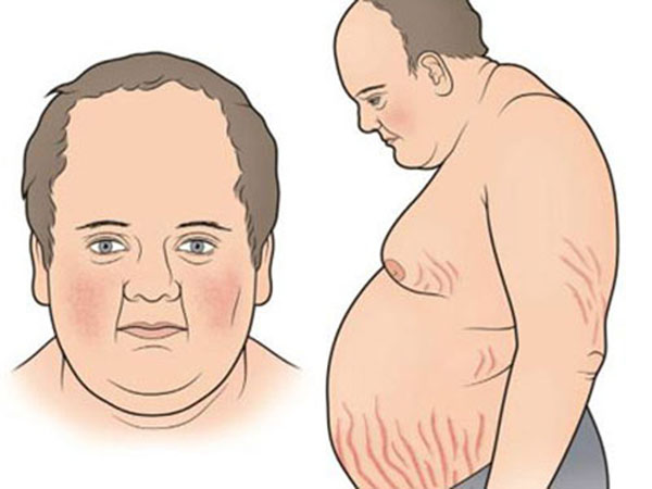 Cushing là bệnh lý có hội chứng đặc trưng béo trung tâm 