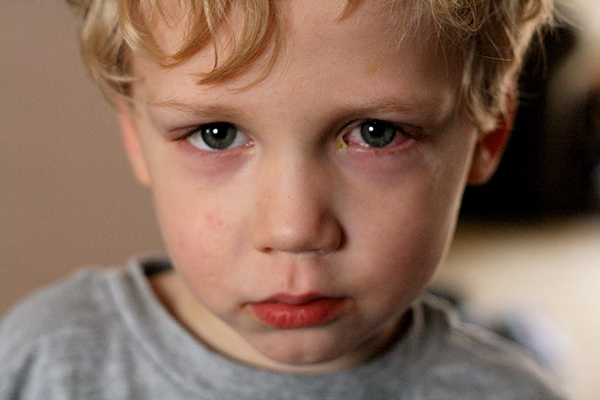 Chăm sóc trẻ bị đau mắt đỏ như thế nào để trẻ nhanh chóng khỏi bệnh