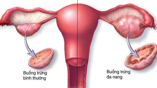 Nguyên nhân, dấu hiệu nhận biết nữ giới mắc buồng trứng đa nang