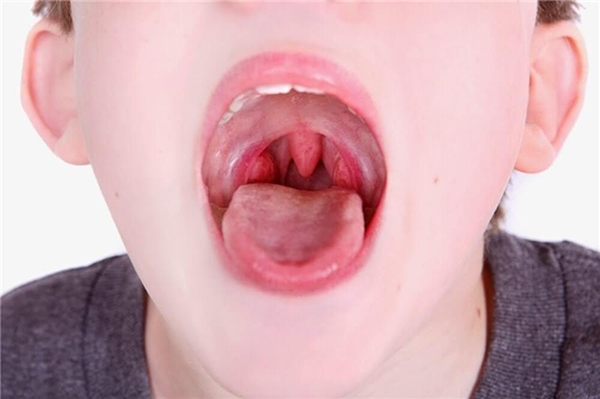 Thường xuyên sử dụng chất kích thích có thể khiến bạn mắc ung thư vòm họng