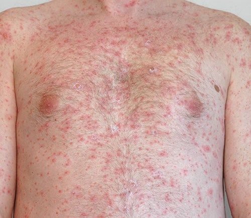 Nổi mẩn đỏ xuất hiện nhiều trên da