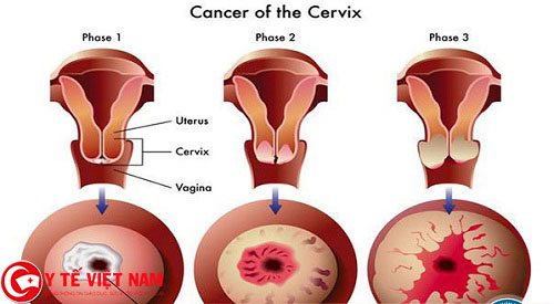 Bệnh viêm lộ tuyến cổ tử cung được chia làm 3 giai đoạn ứng với 3 cấp độ tổn thương khác nhau.