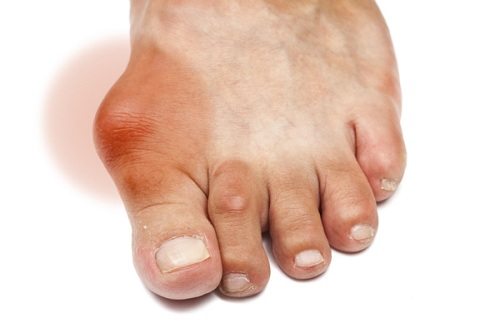 Bệnh Gout cấp tính gây rất nhiều đau đớn cho người bệnh 