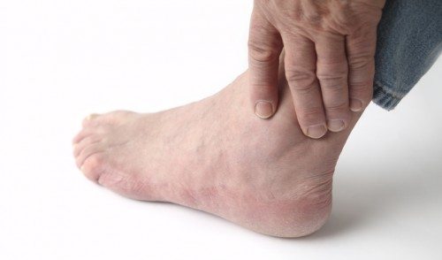 Bệnh Gout cần kiên trì điều trị lâu dài 