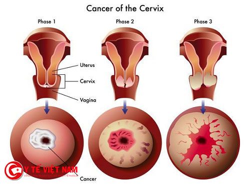 Các giai đoạn phát triển của viêm lộ tuyến cổ tử cung 