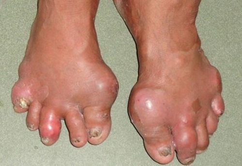 Tiết lộ 4 nguyên nhân gây ra bệnh Gout ít ai ngờ đến - 2
