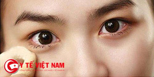 Bệnh lậu ở mắt rất nguy hiểm, bệnh có thể gây viêm, đau, sưng đỏ mắt