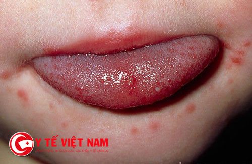 Khoang miệng bị sưng và đau họng là biểu hiện của bệnh lậu