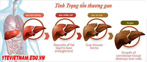 men_gan_tang_cao_co_the_phat_trien_thanh_xo_gan_va_ung_thu_gan